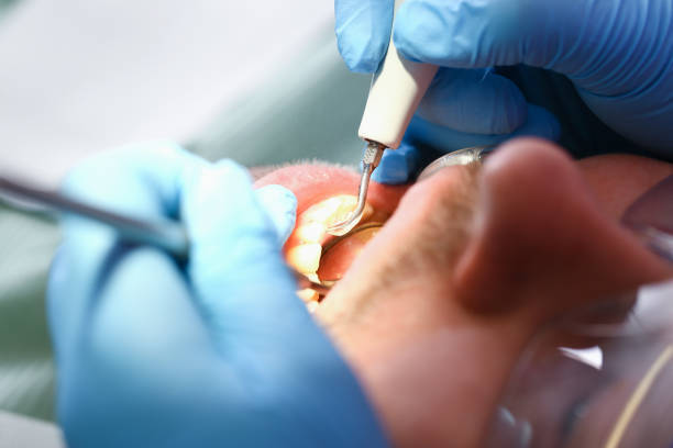 Best Dental Abscess Treatment in Kingsville, MD